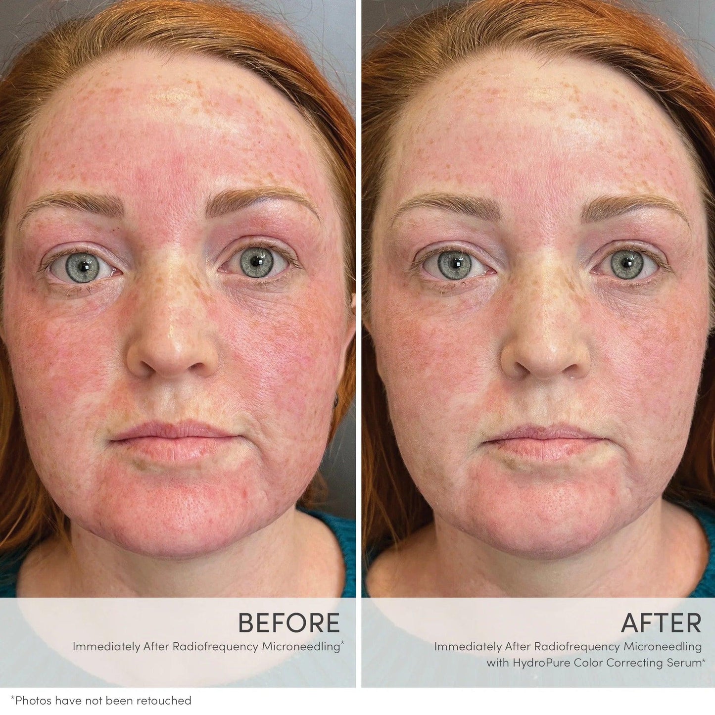 HydroPure™ Color Correcting Serum with Hyaluronic Acid & CoQ10