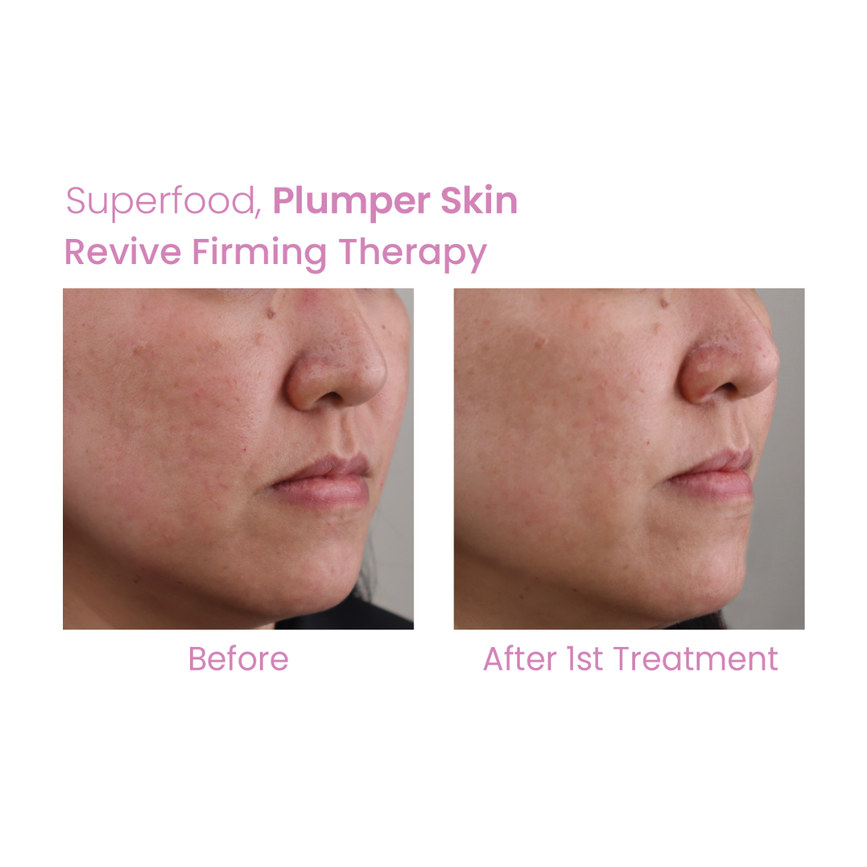 Revive Firming Therapy